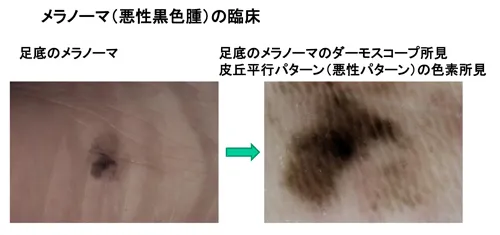 メラノーマ