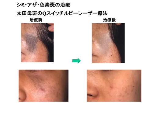 色素斑