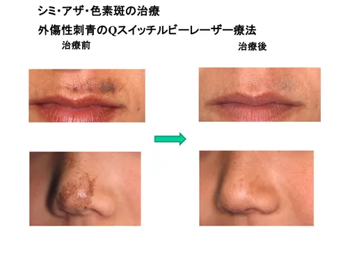 外傷性刺青