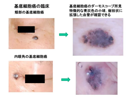 基底細胞癌